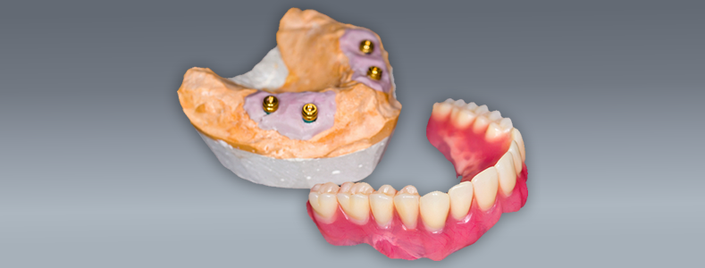 implant-denture-solutions