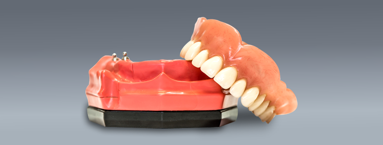 implant-retained-dentures