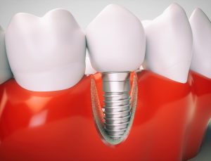 Dental Implants Lower Floating