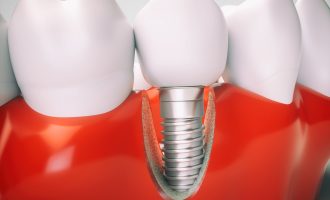 Dental Implants Lower Floating